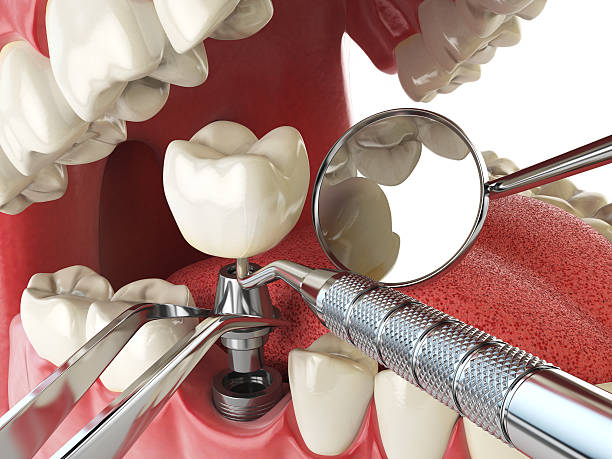 Best Emergency Denture Repair in Wilkes Barre, PA